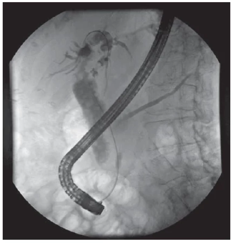 ERCP: masivní dilatace choledochu a intrahepatálních
žlučových cest s vícečetnou litiázou. <br> 
Fig. 1. ERCP: massive dilatation of the choledochus and intrahepatic
bile ducts with multiple lithiasis