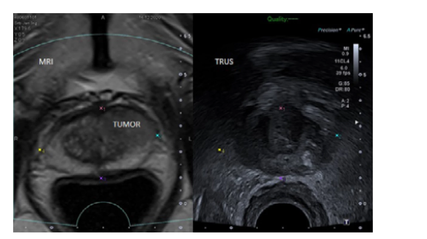 MRI/TRUS fúzní zobrazení prostaty s ložiskem
charakteru PIRADS 5 v levém laloku ventrálně vhodném
k TPBxP (archiv autora)<br>
Fig. 6. MRI/TRUS fusion images of the prostate with
a PIRADS 5 lesion in the anterior part of the left lobe
sutable for TPBxP (author’s archive)