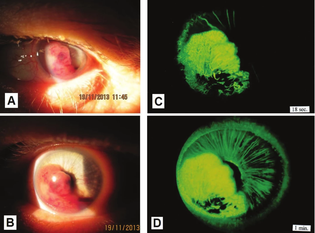 Macro photo of anterior segment with melanoma growing into the anterior chamber (A, B); fluorescence angiography of the same patient (C, D) – the tumour is before the planned irradiation on a linear accelerator. 