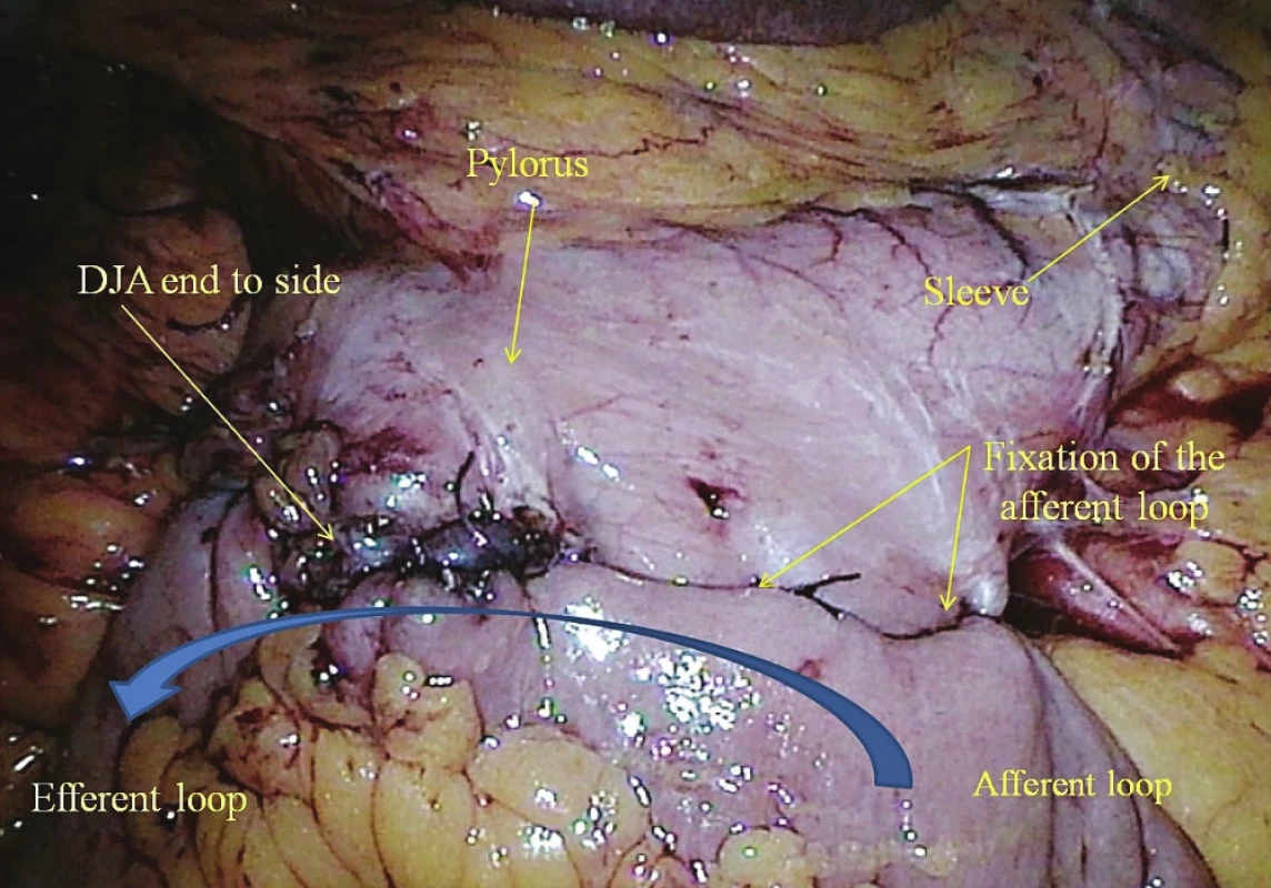 Ručně šitá duodeno-ileální anastomóza<br>
Fig. 4: Hand-sewn duodeno-ileal anastomosis