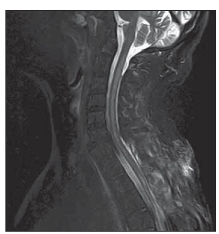 MR hrudní a krční páteře, sekvence
STIR, sagitální rovina. Pooperační změny,
regrese expanze míchy vč. edematózních
změn.<br>
Fig. 2. MRI of cervical and thoracic spine,
STIR sequence, sagittal plane. Postoperative
changes with regression of spinal
cord expansion including edematous
changes.