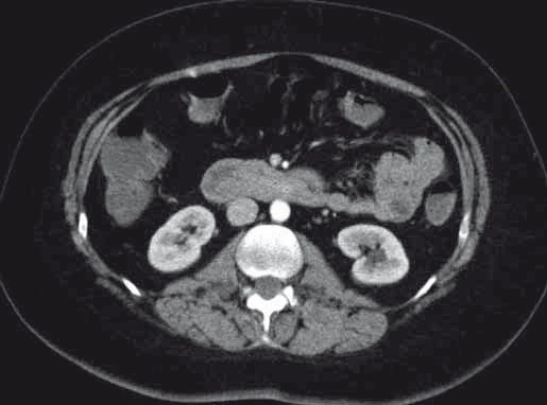 CT – invaginácia duodéna na podklade intraluminálne lokalizovaného nádoru.<br> Fig. 5. CT – duodenal intussusception due to an intraluminal tumour.