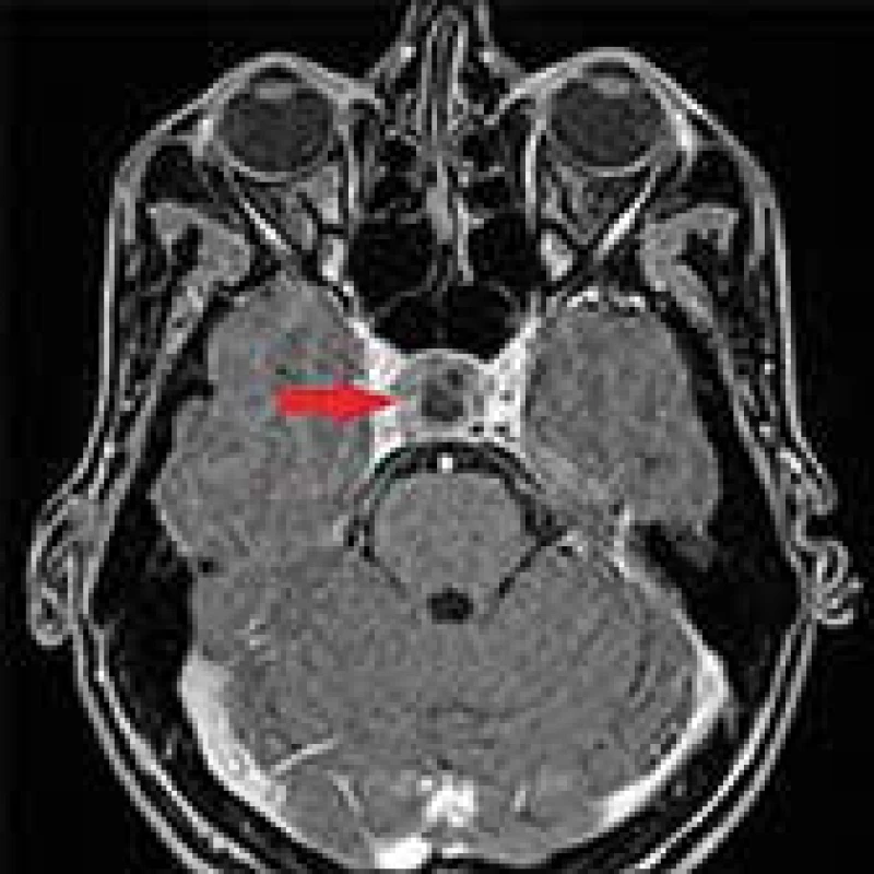 Predoperačné MRI vyšetrenie (axiálny rez)
s nálezom makroadenómu hypofýzy veľkosti
25 × 18 × 18 mm