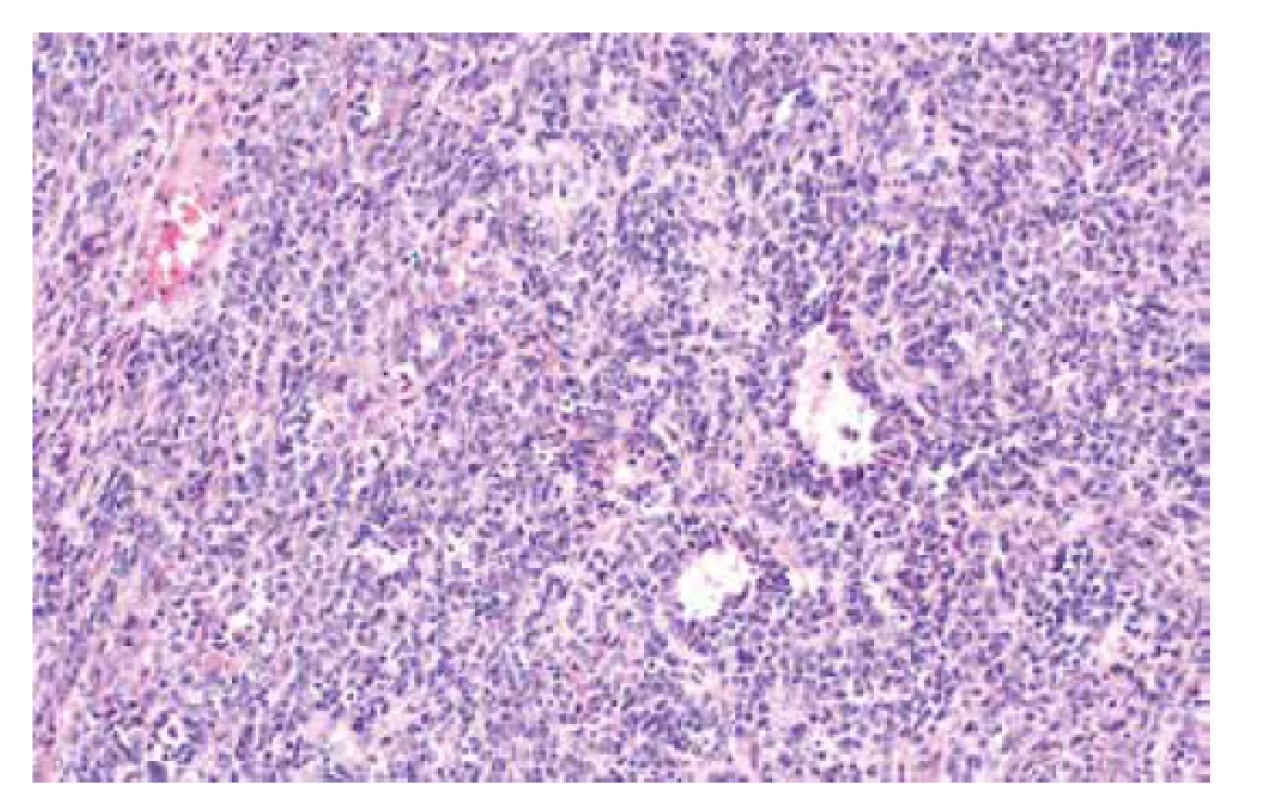 Malobuněčný karcinom ovaria hyperkalcemického typu (barvení HE,
200x).
