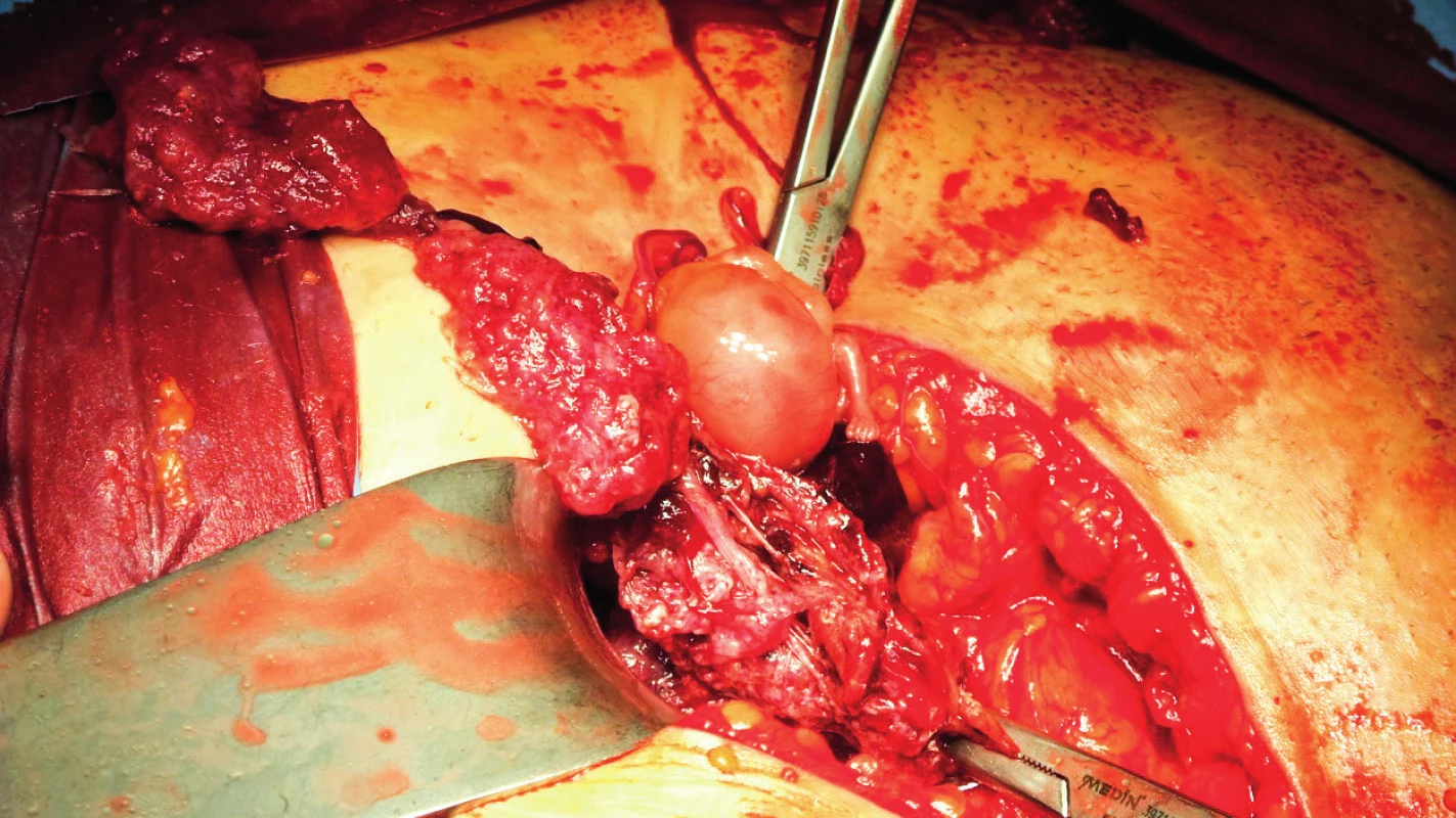 Operační nález při laparotomické revizi před provedením
salpingektomie