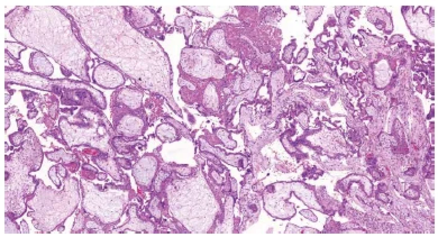 Trizomie chromozomu 21. Nepravidelné choriové klky s mírným edémem
stromatu, trofoblastickými inkluzemi a fokální hyperplázií trofoblastu
(HE, 50x).