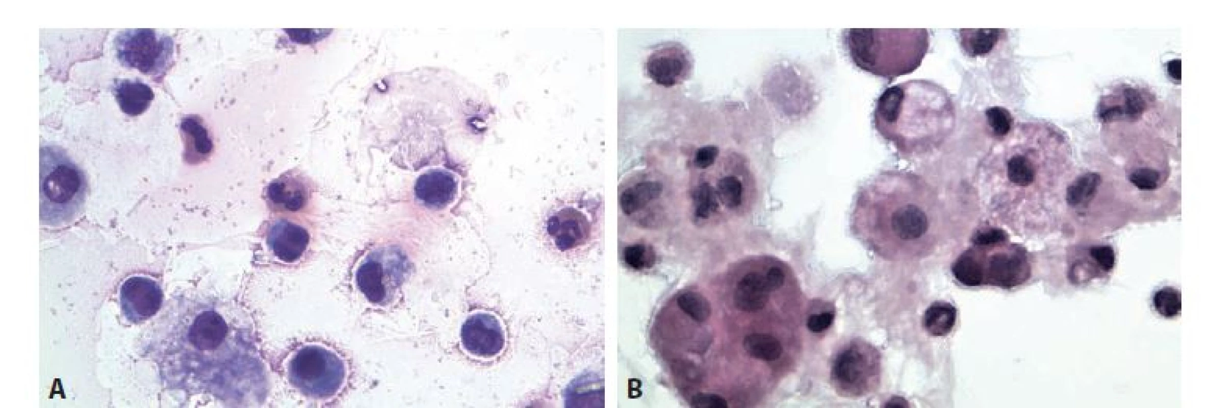 Sérologicky potvrzená borelióza. Muž 68 let, kolenní kloub.<br>
A: Monocyty, eozinofi lní granulocyty, narušené synovialocyty. MGG, 600x.<br>
B: Skupinka synovialocytů, monocyty, makrofágy, lymfocyty, neutrofi lní granulocyt. HE, 600x.