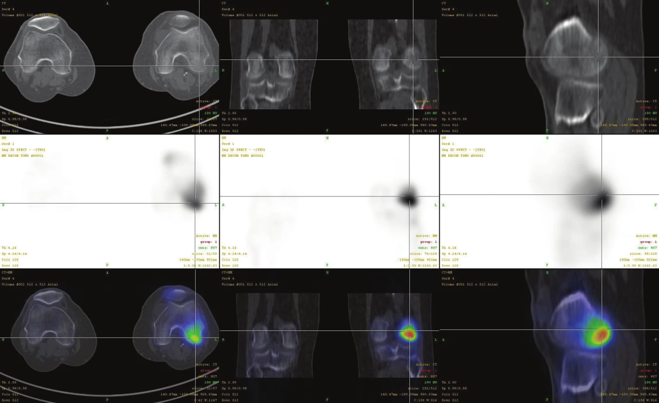 Fúze SPECT/CT obrazu u pacienta s disekující osteochondritidou v méně časté lokalizaci v inferocentrální části laterálního kondylu
femuru v časném stádiu I. V horní řadě je obraz z LDCT postupně v transaxiální, koronární a sagitální rovině. Střední řada ukazuje odpovídající
SPECT řezy. Dolní řada prezentuje odpovídající fúzované SPECT/CT řezy. Scintigrafický nález je v časném stádiu výrazný, nález na
LDCT normální.