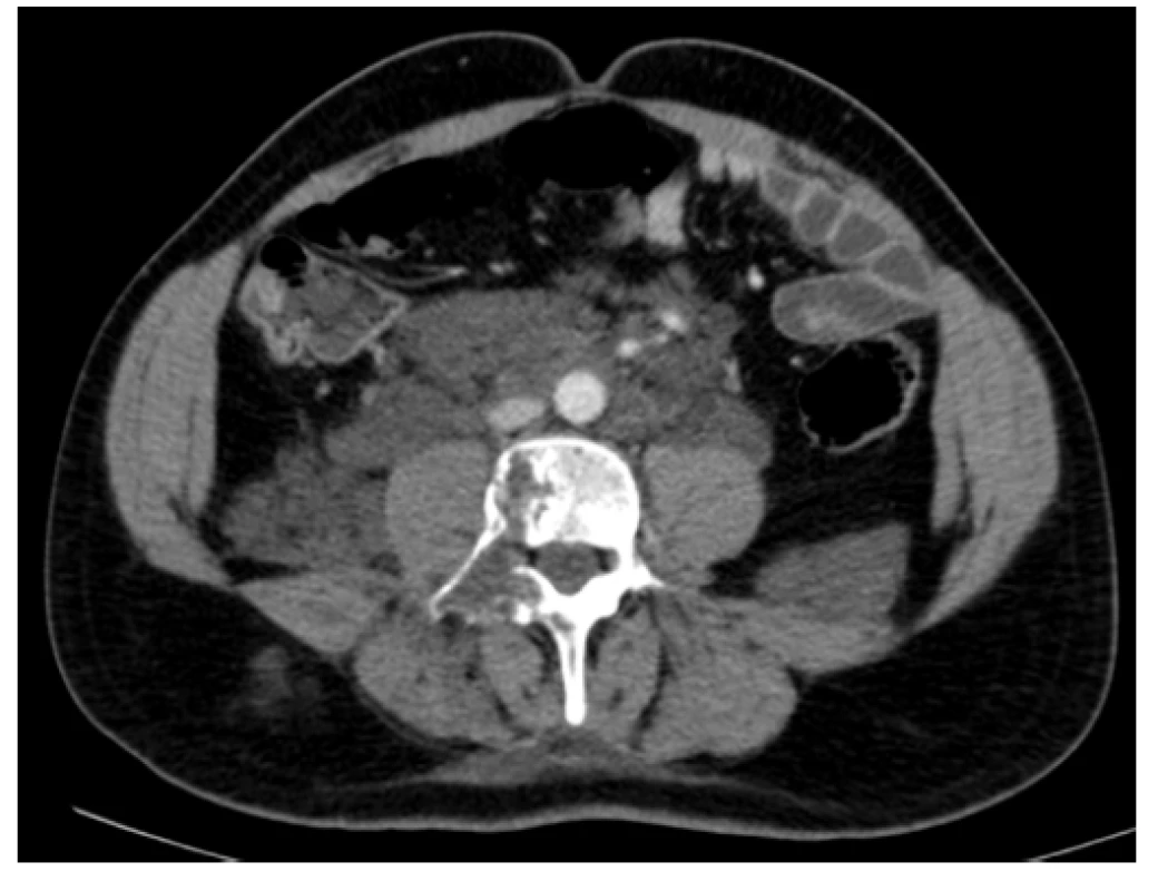 Kontrastní CT scan (axiální rovina) – patologická masa v oblasti
retroperitonea s propagací podél psoatů