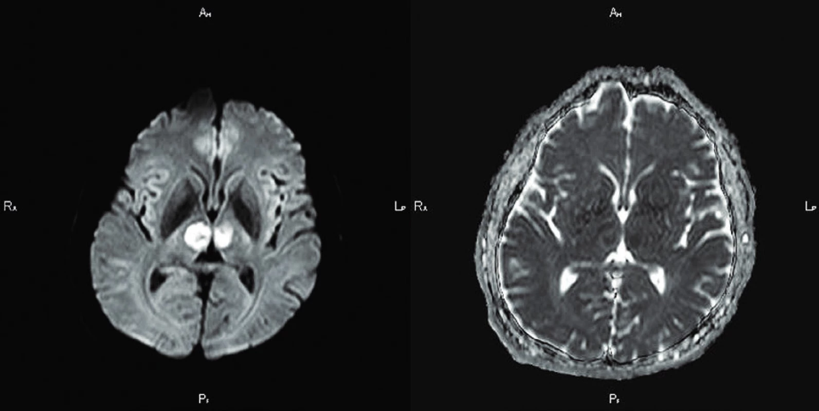 MR vyšetření mozku
Axiální DWI/ADC prokazují ischemii v obou talamech