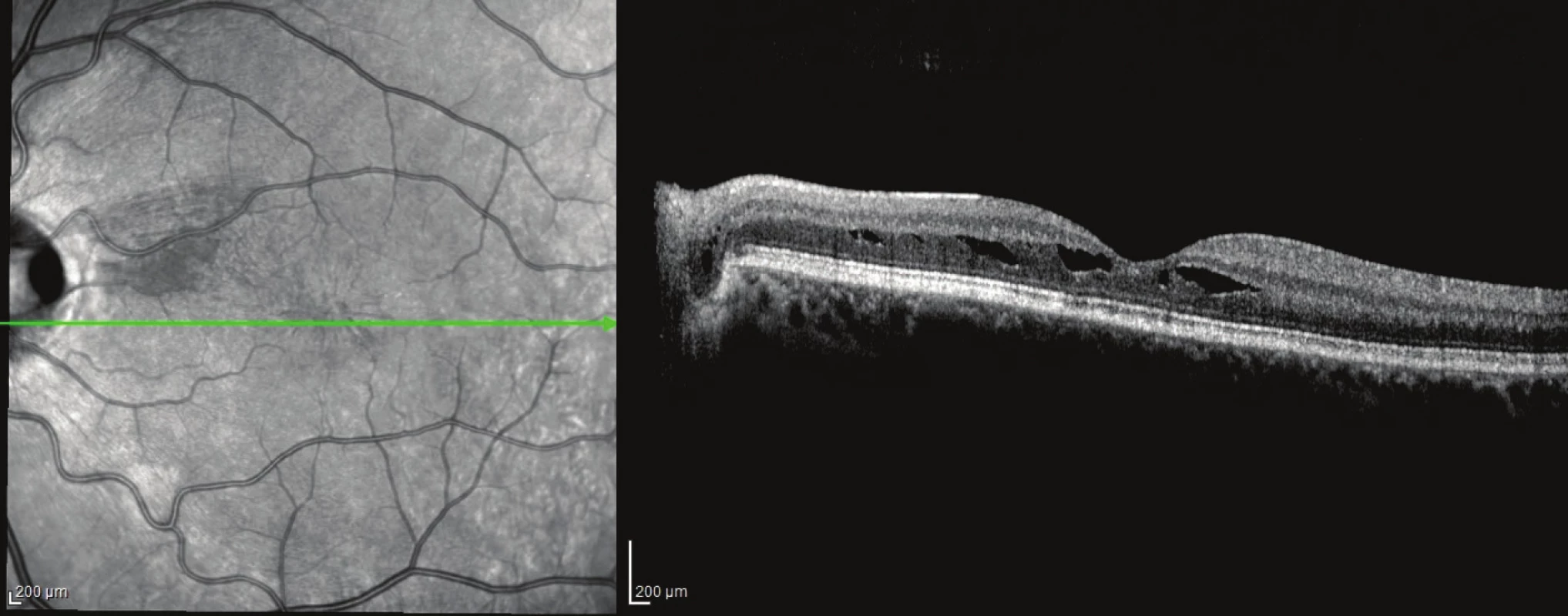 Patient no. 4 Linear horizontal transpapillary OCT scan of LE after PPV, resorption of subretinal fluid and closed communication between the optic disc pit and macular retinoschisis of external layer of retina