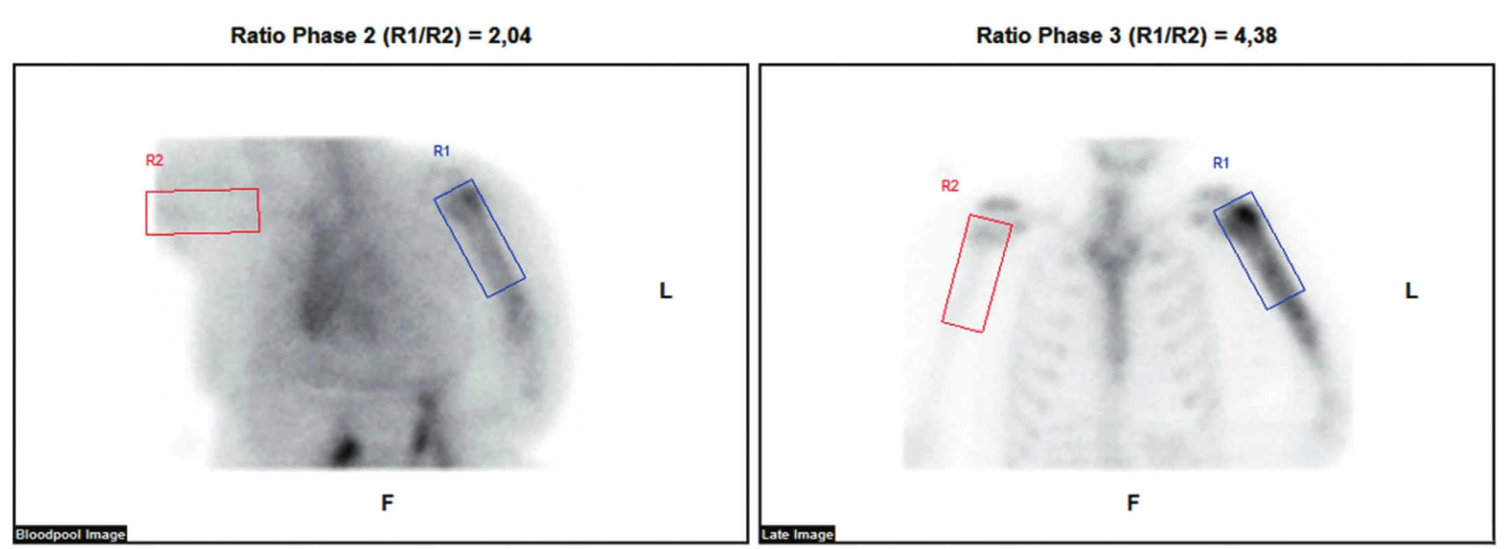 Provedená třífázová scintigrafie skeletu ukazuje ve fázi blood poolu nasnímané 5 minut po aplikaci radiofarmaka zvýšené tkáňové
prokrvení v oblasti diafýzy levé pažní kosti. Ve třetí fázi nasnímané za 2 h po aplikaci radiofarmaka je aktivita akumulována zvýšeně v proximálních
2/3 diafýzy s maximem v hlavici laterálně.
