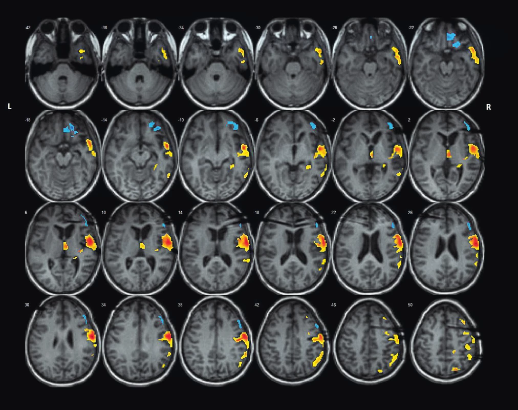 Pozice intracerebrálních EEG elektrod na MRI mozku ve vztahu ke koregistrovanému
maximu loko-regionálního FDG hypometabolismu dle
SPM-PET analýzy metodikou asymmetry index (stejná pacientka jako
na obr. 2).<br>
Fig. 3. Position of intracerebral EEG electrodes on brain MRI scan in relation to
co-registered regional FDG hypometabolism acc. to SPM-PET analysis
by Assymetry Index Method (the same patient as on the fig. 2).