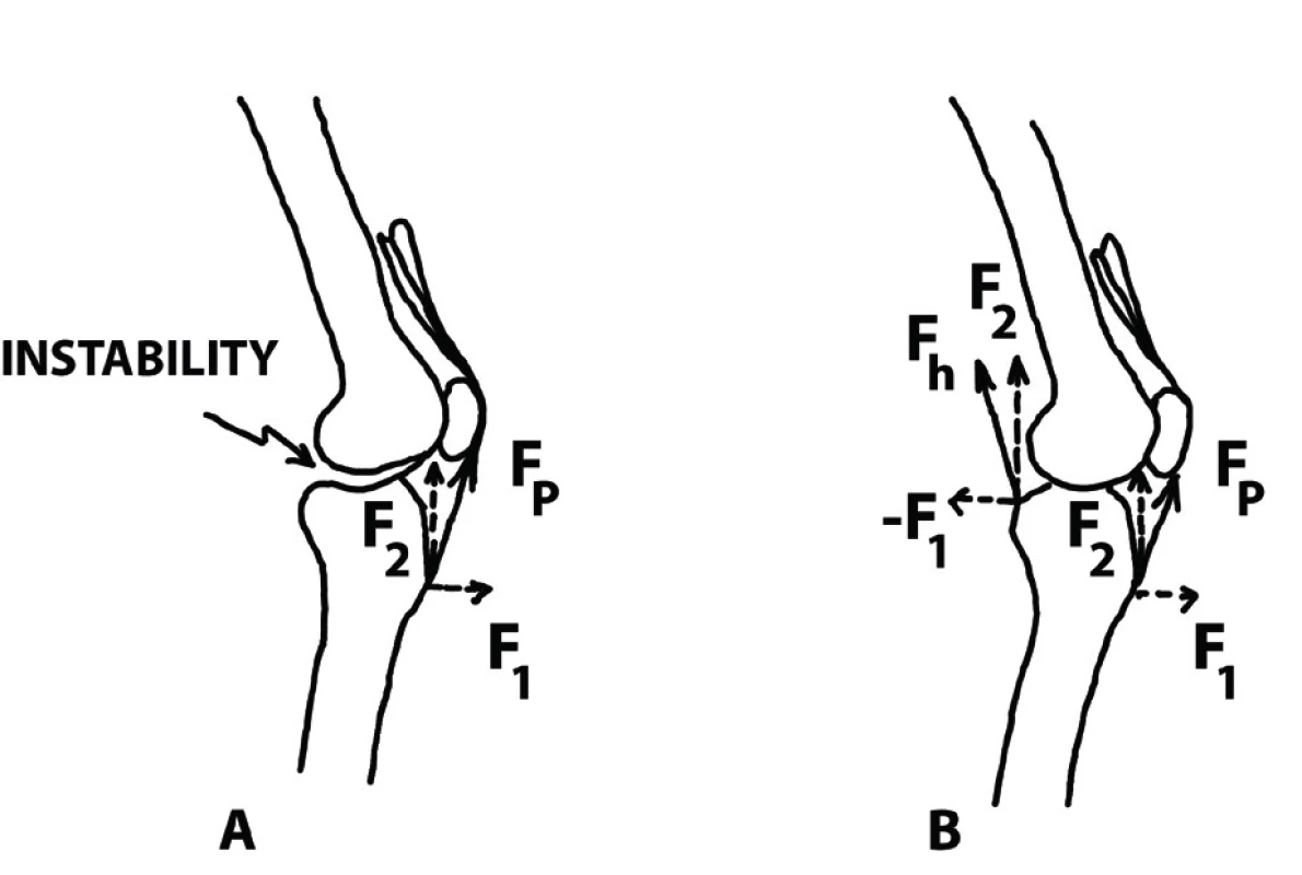 Zobrazení tlakového působení při instabilitě kolena.