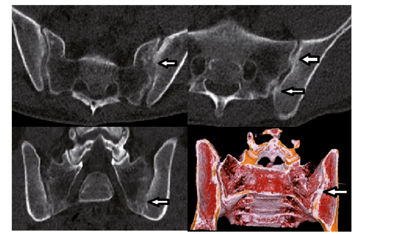 Nízkodávkové CT s cínovou filtrací (Sn LDCT). Pacient s oboustrannou sakroiliitidou, vpravo stupeň 2, vlevo stupeň 3, na 3D
rekonstrukci je výřez v místě vytvořeného kostního můstku vlevo (šipka).