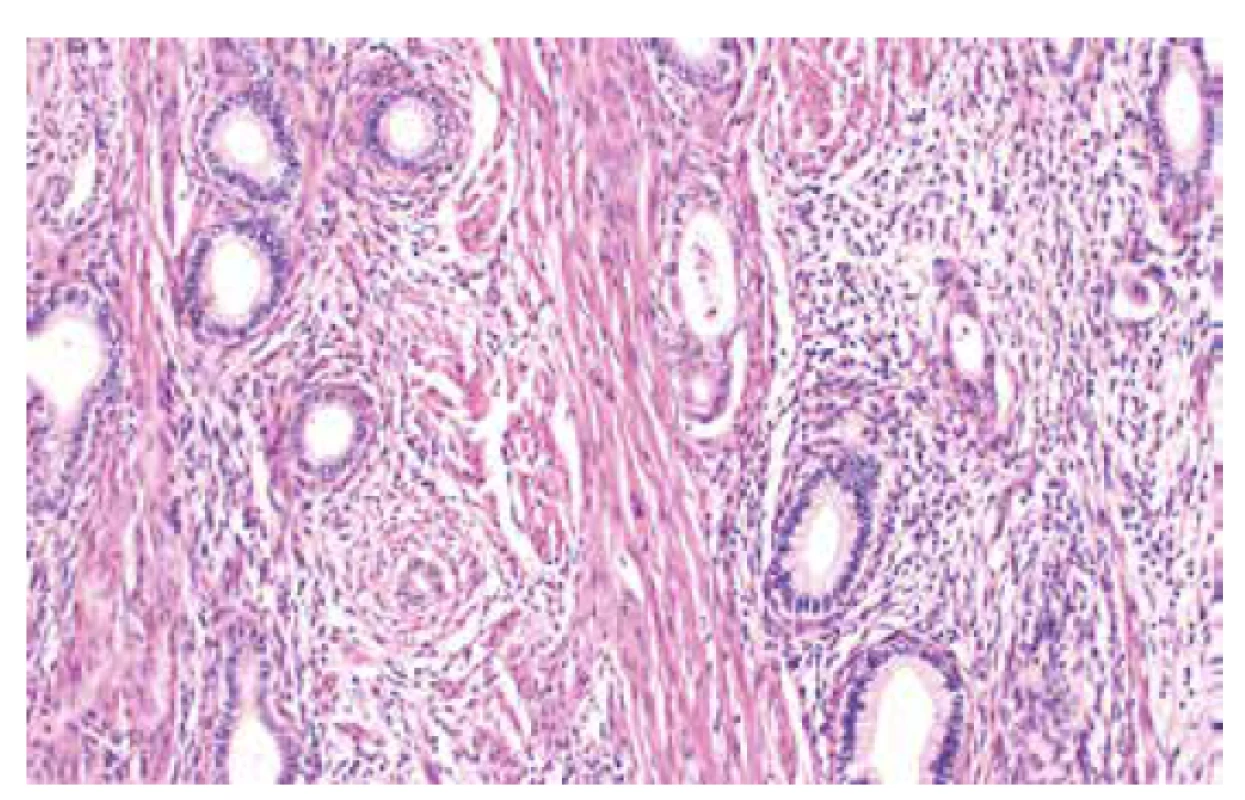 Dobře diferencovaný adenokarcinom děložního hrdla gastrického
typu (barvení HE, 200x).