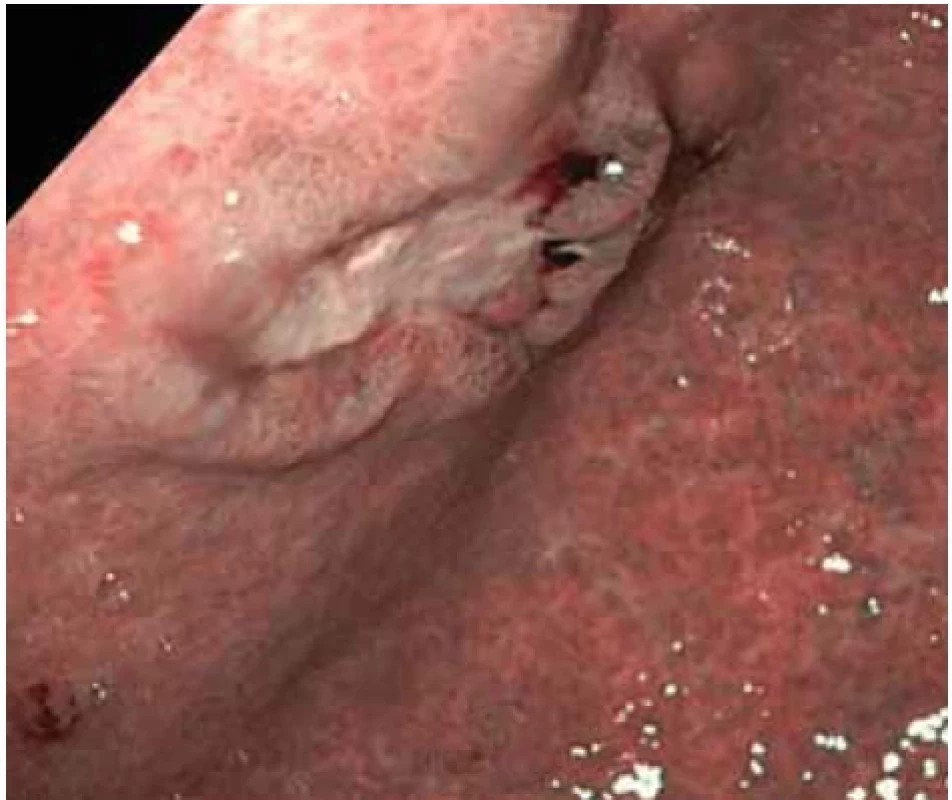Vředová léze na přední stěně na přechodu těla a antra žaludku (NBI) – první kontrolní gastroskopie.</br> Fig. 4. Ulcer lesion on the front wall at the junction of the body and antrum of the stomach (NBI) – the fi rst control gastroscopy.
