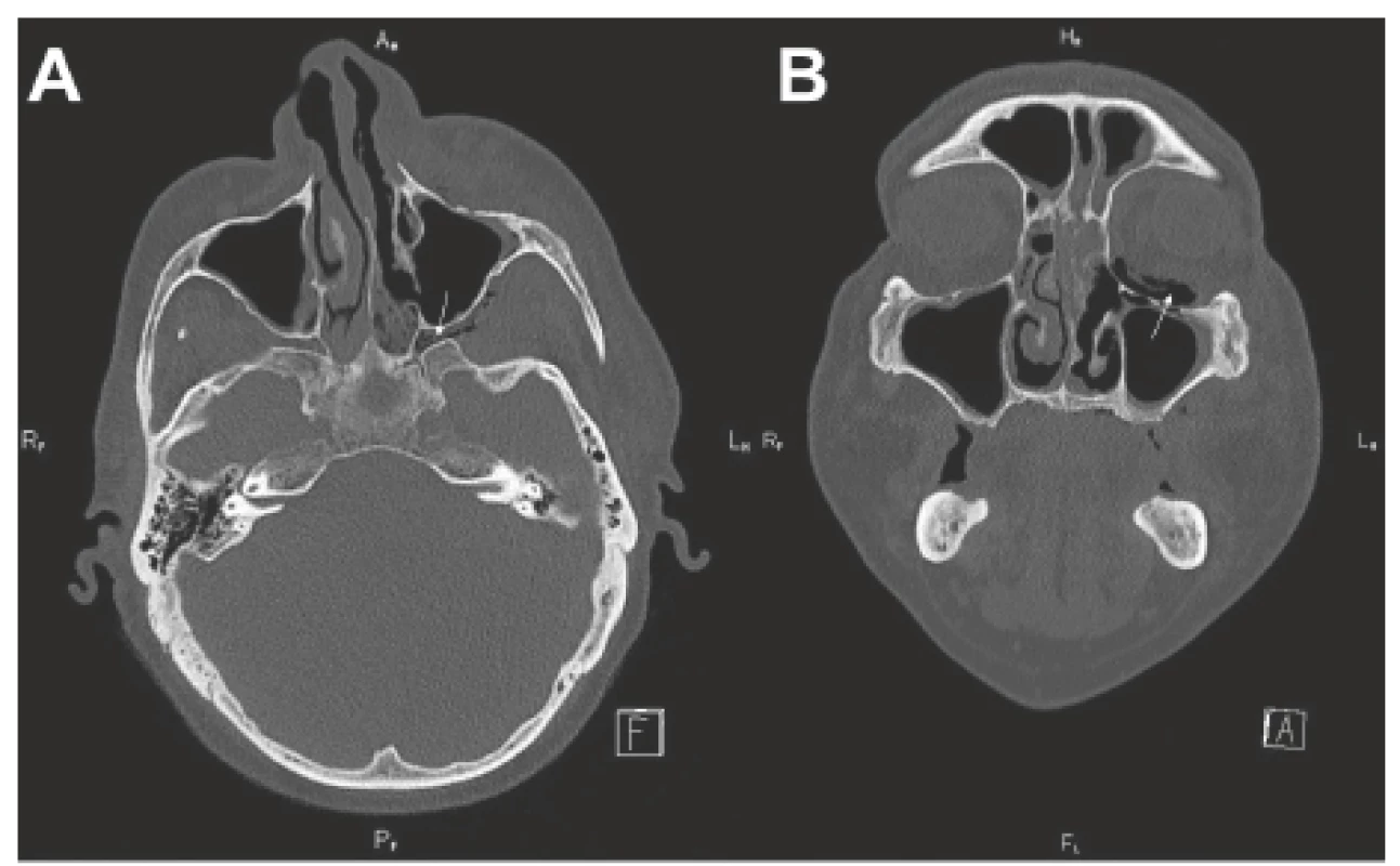 CT vedlejších nosních dutin - předoperačně před radikálním
chirurgickým resekčním výkonem.<br>
A-axiální projekce (infiltrace fossa pterygopalatina vlevo - viz šipka);
B-koronární projekce (pneumoorbita - viz šipka)