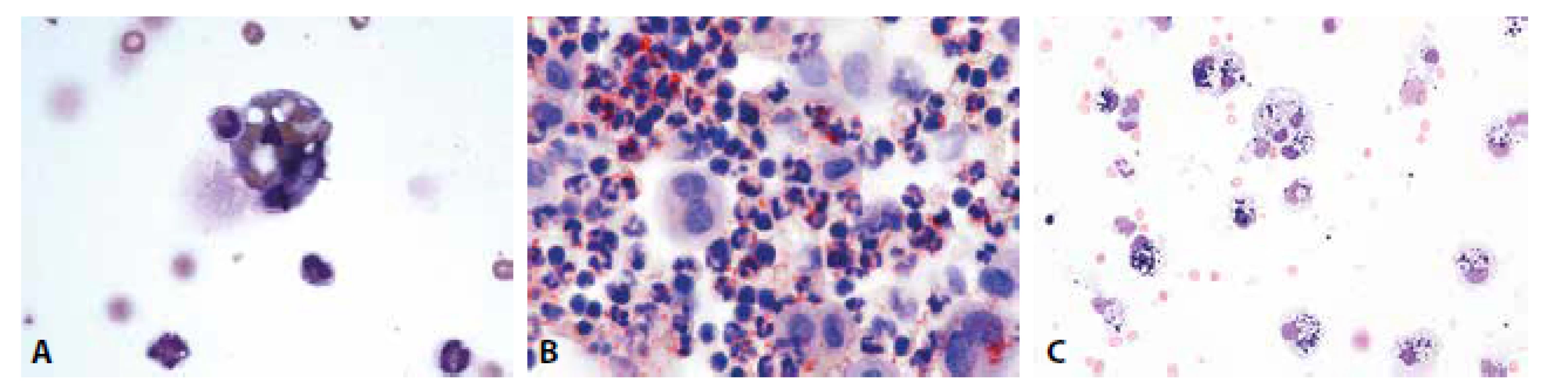 (A) Erytrofygocytóza v rámci tkáňové léze. V cytoplazmě makrofága zčásti odbarvené erytrocyty. Neutrofilní granulocyt jako známka tkáňové léze ve fázi
iniciálního pohlcení. (B) Úklidová reakce v barvení olejovou červení. Dystrofické steatóza neutrofilních granulocytů, pozitivita lipidů v cytoplazmě makrofágů.
(C) Úklidová reakce posthemoragická. Makrofágy s železitým pigmentem. MGG, 400.