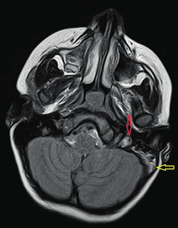 MRI, FLAIR, předoperačně, obtékaný defekt v bulbu
v. jugularis interna vlevo (červená šipka), patologický obsah mastoidních sklípků vlevo (žlutá šipka)