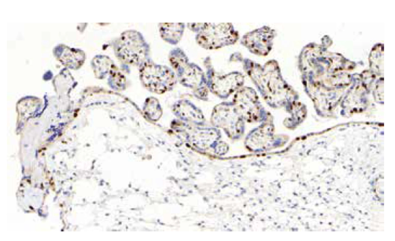 PMD. Ložisková pozitivita p57 v cytotrofoblastu a ztráta exprese p57
v buňkách stromatu kmenových klků. V distálních choriových klcích je exprese
p57 zachována (p57, 200x).
