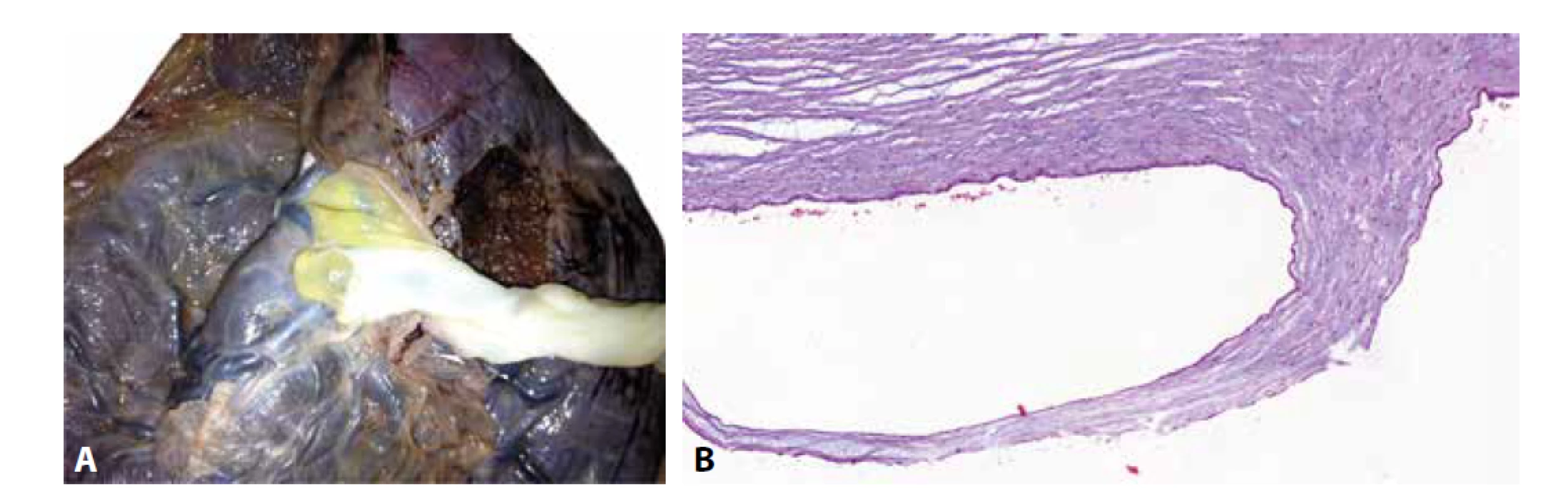 A: Amniální cysty v místě inzerce pupečníku k choriové plotně. B: Amniální cysta pupečníku vystlaná jednovrstevným epitelem (HE, 100x).