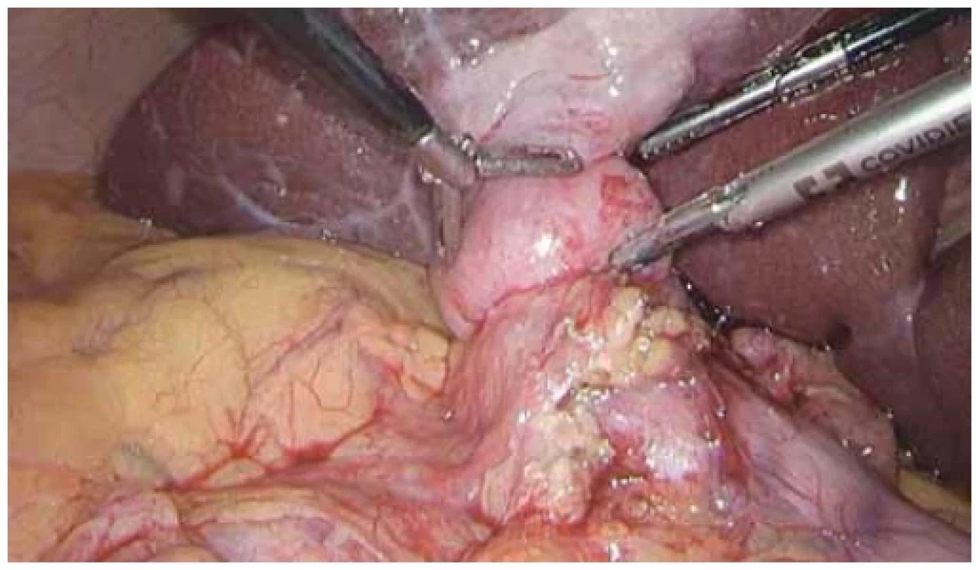 Laparoskopický nález LAMS ve žlučníku a duodenu. <br> 
Fig. 11. Laparoscopic fi nding of LAMS in the gallbladder and duodenum.