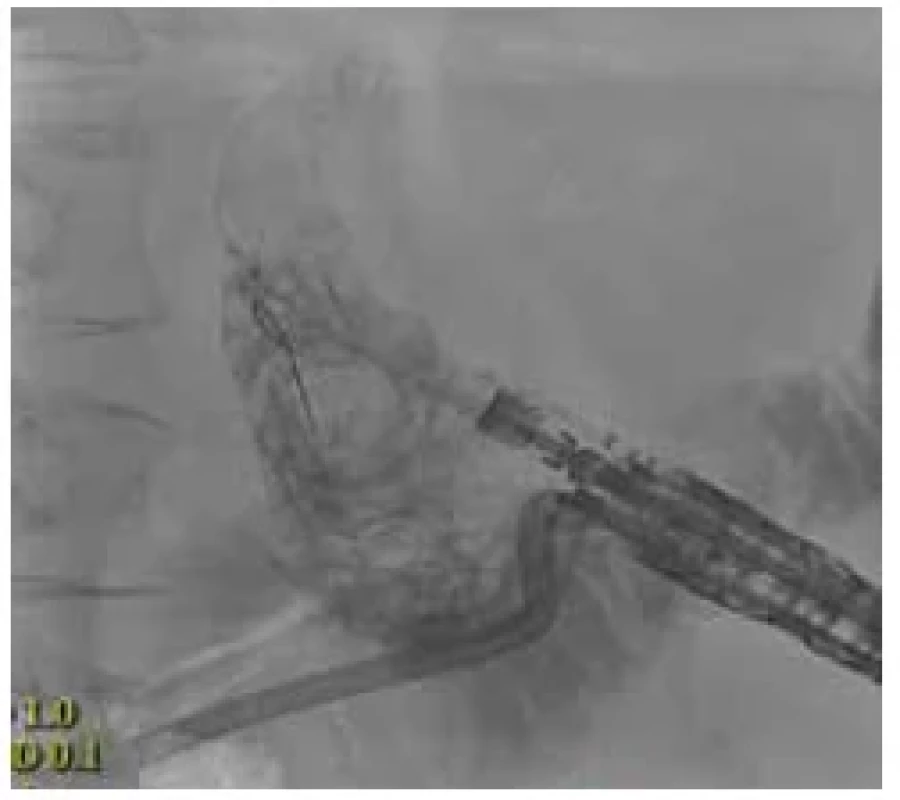 Skiaskopické zobrazení výměny
zevní drenáže žlučníku za vnitřní. <br> 
Fig. 5. X-ray image of replacing the external
drainage of the gallbladder with an internal
one.