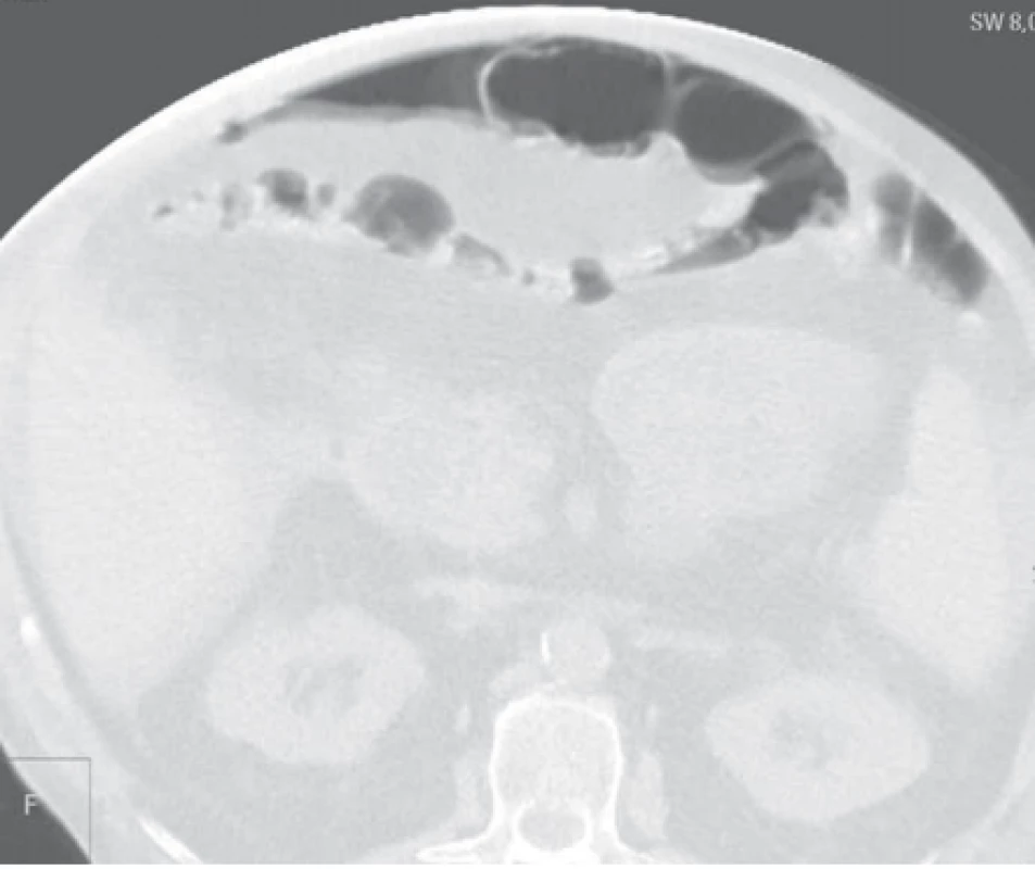CT vyšetření břicha, pneumoperitoneum, volný plyn pod břišní stěnou.<br>
Fig. 4. CT image of the abdomen, with a pneumoperitoneum, and free gas under
the abdominal wall.