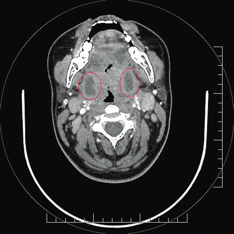 CT obraz obojstranného peritonzilárneho abscesu
u pacientky.