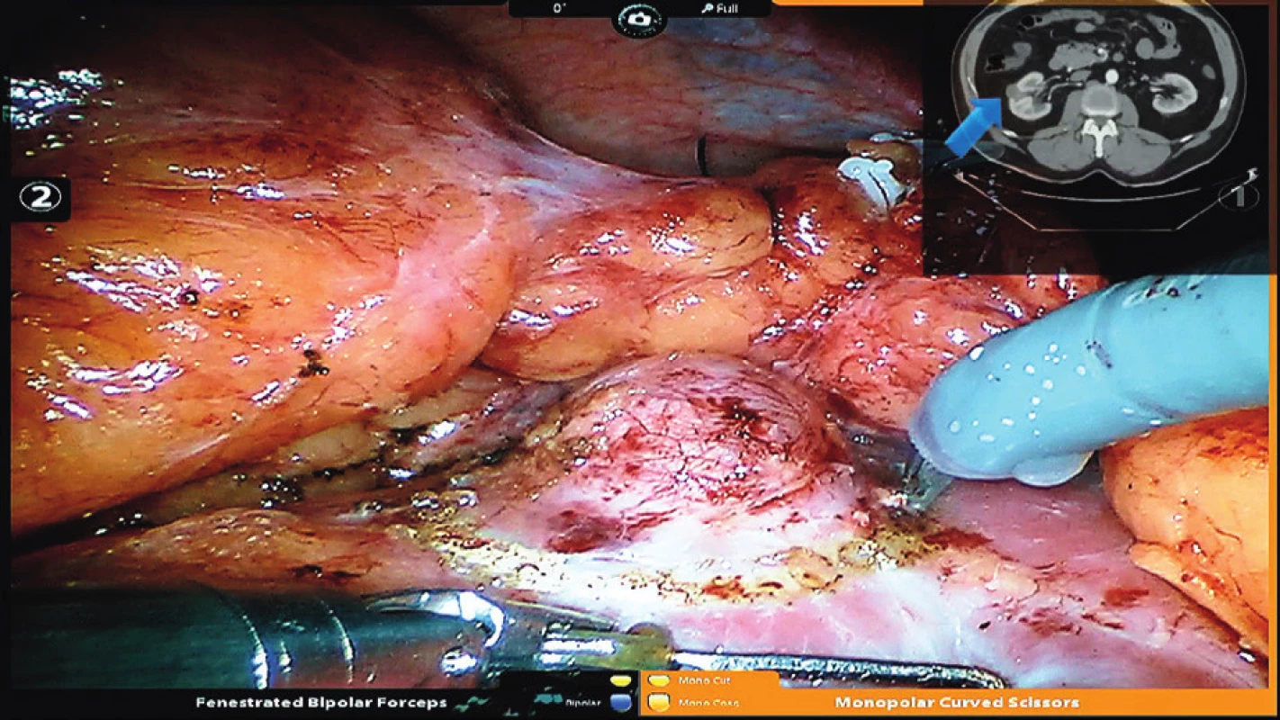 Perioperační obraz robotické resekce tumoru pravé
ledviny s CT obrazem v levém horním rohu