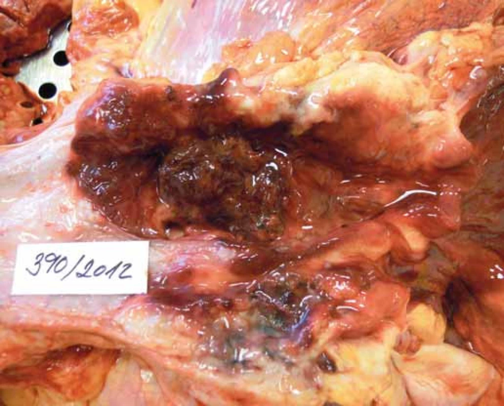 Karcinom jícnu.<br>Fig. 1. Oesophageal carcinoma.