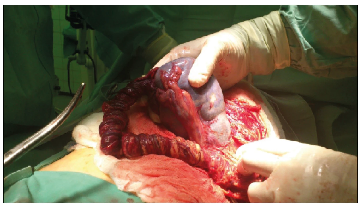 Intraoperative finding 