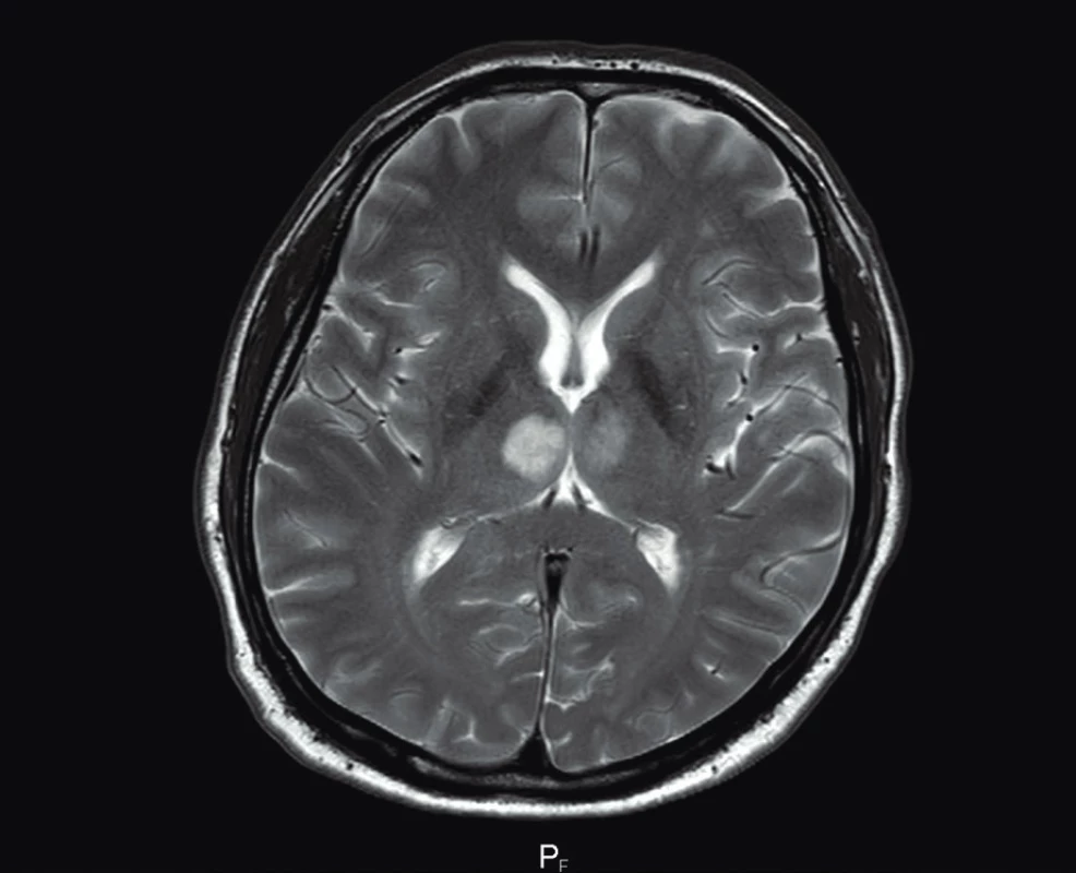 MR vyšetření mozku
Axiální T2 WI prokazují hypersignální ložiska v obou talamech
