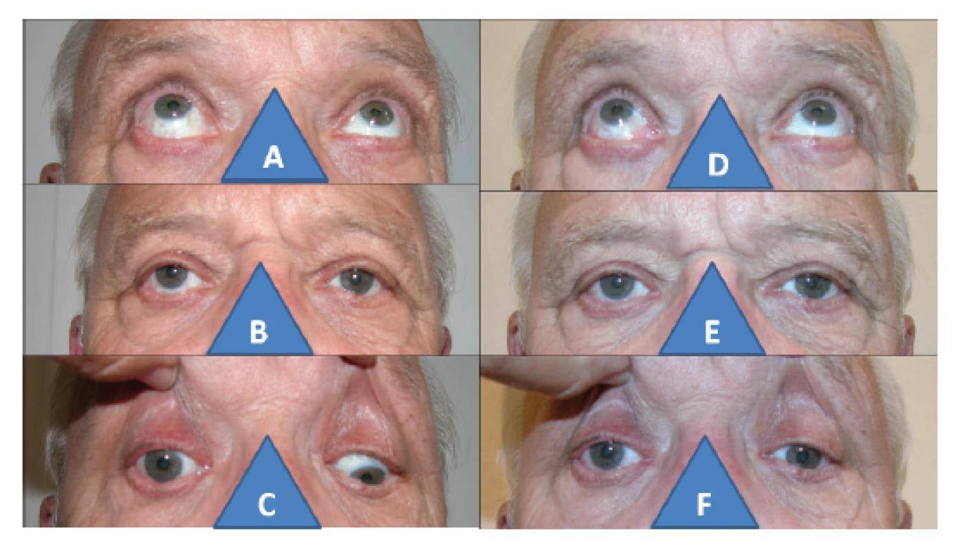 67-letý muž s poúrazovou parézou dolního přímého
svalu vpravo: zvýšená elevace vpravo (A), hypertropie vpravo (B),
nulová deprese vpravo (C), normalizace elevace po operaci (D),
paralelní postavení očí po operaci (E), pouze náznak deprese po
operaci vpravo (F)