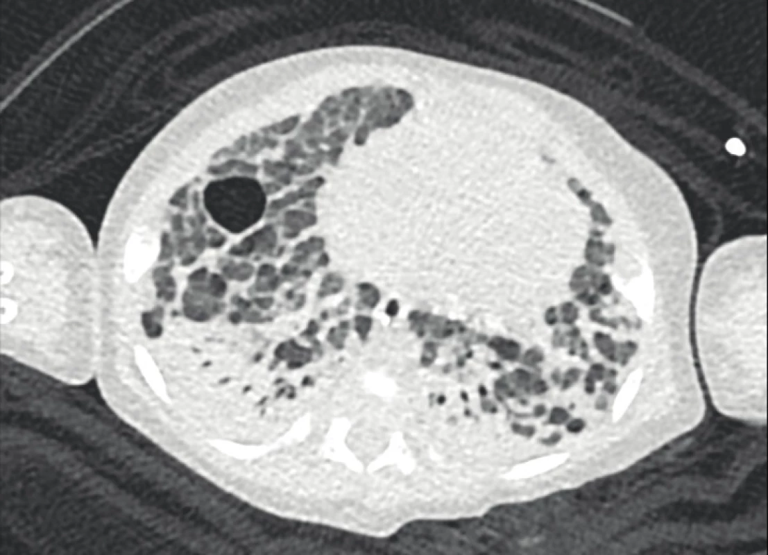 Počítačová tomografie plic u stejného chlapce s těžkými bulózními a emfyzematózními změnami při fibroproliferativní přestavbě plíce připomíná obraz „old“
BPD (archiv Radiodiagnostické kliniky 1. LF UK a VFN).<br>
Fig. 2. Chest computed tomography scan in the same boy with
severe bullous and emphysematous changes as a consequence of fibroproliferative lung remodelling resembles
the image of „old“ BPD (archive of the Department of
Radiology, First Faculty of Medicine, Charles University
and General University Hospital in Prague).