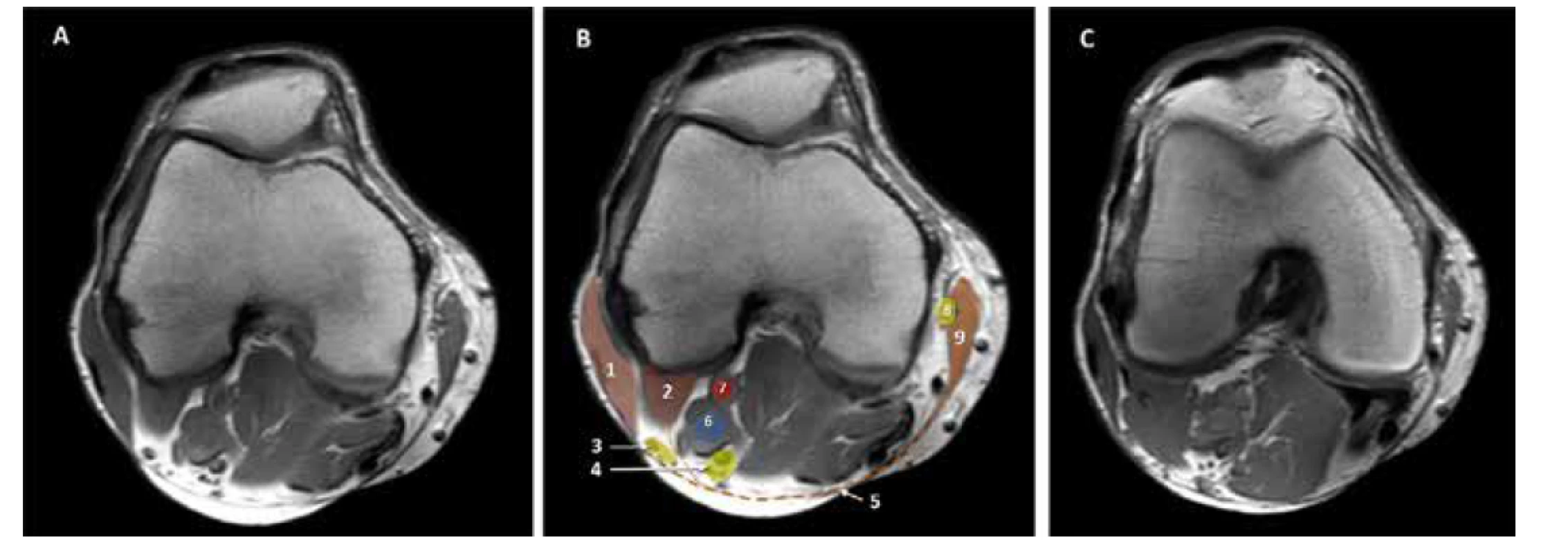 MRI kolena. A. nativní obraz. B. kolorovaný obraz: 1. m. biceps femoris, 2. zevní hlava m. gastrocnemius, 3. nervus peroneus communis, 4. n. tibialis,
5. hluboká fascie, 6. vena poplitea, 7. arterie poplitea. 8. n saphenus, 9. m sartorius. C. nativní obraz: horizontální řez 3 mm distálněji než A a B. Zevní hlava
m. gastrocnemius je mohutnější a zcela odděluje n. tibialis od n. peroneus