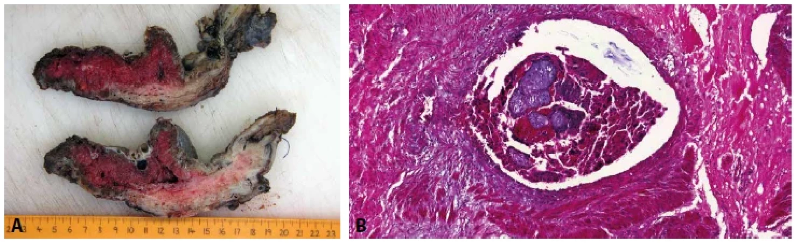 A: Placenta increta. Řezy děložní stěnou s patrným prorůstáním placenty do myometria. B: Placenta increta. Choriové klky v žíle stěny
děložní (HE, 200x).