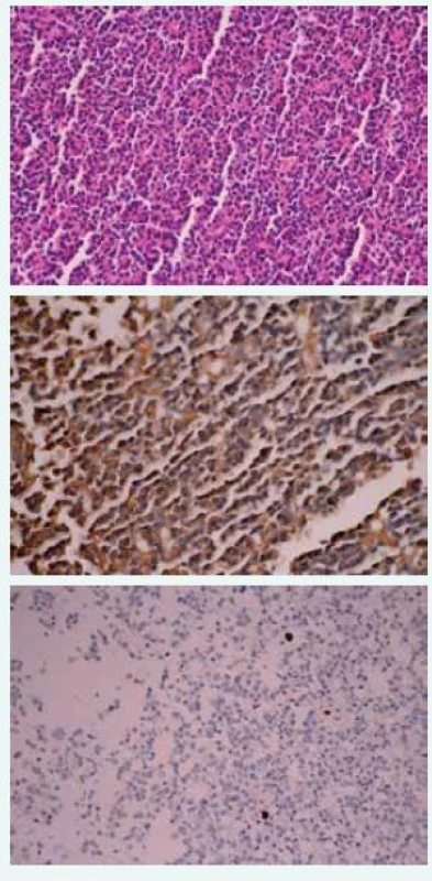 Imunohistochemické vyšetrenie tkaniva
makroadenómu hypofýzy