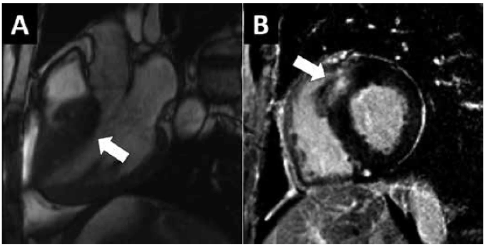 MR vyšetření hypertrofické KMP. 54 letá žena s těžkou hypertrofií LK
bez obstrukce v LVOT. A) Zobrazení MR sekvencí „světlé krve“ ve 3-dutinové
rovině v diastole. Výrazná hypertrofie septa s maximem ve střední části (šipka).
B) Vyšetření pozdního nasycení gadoliniem zobrazuje výrazné ložisko
pozdního sycení v předním septu (šipka).