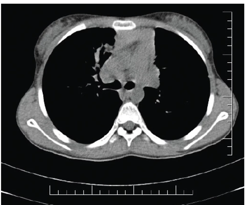High-attenuation mucus (HAM) prítomný vpravo parakardiálne
u našej pacientky (#005).<br>
Fig. 3. High-attenuation mucus (HAM) present in the righ
lung field paracardially in our patient (#005).