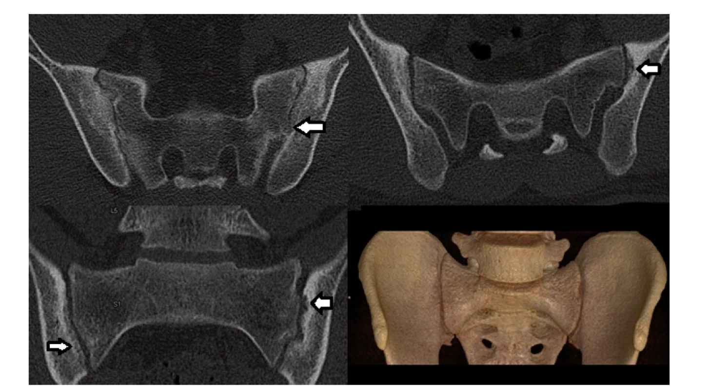 CT se standardní dávkou. Pacient s oboustrannou sakroiliitidou – 3. stupně vpravo a 2. stupně vlevo. Patrné usurace,
subchondrální skleróza, vpravo na prvním snímku patrný kostní můstek (šipka).