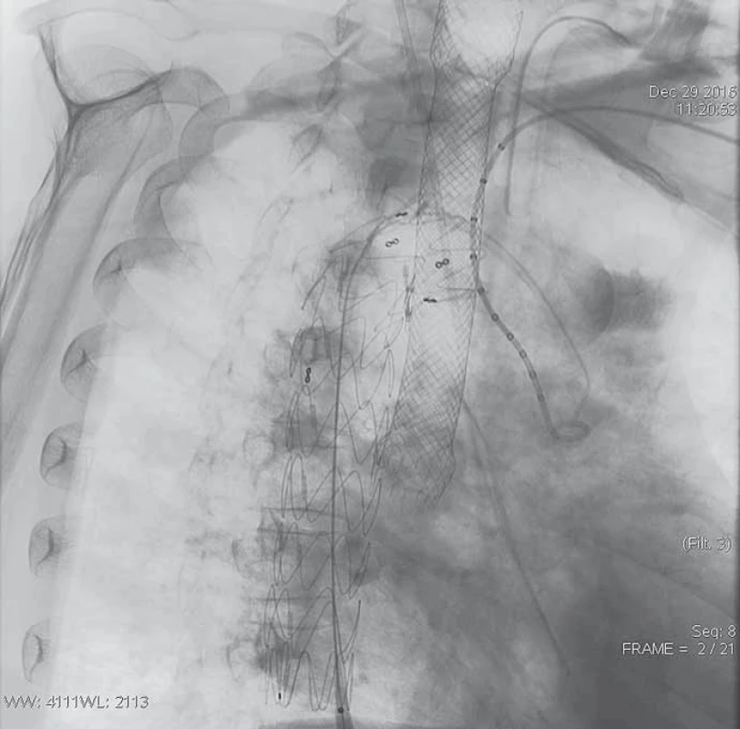 Stentgraft do sestupné hrudní aorty.<br> Fig. 4. Stent graft to the descending thoracic aorta.