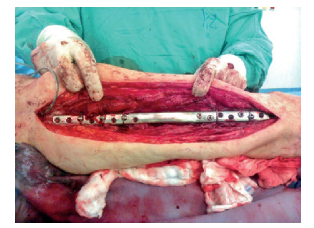 Peroperační foto – 3. reoperace (předehnutá dlaha)<br>
Fig. 8: Intraoperative picture – the 3rd revision surgery
(wave plate)
