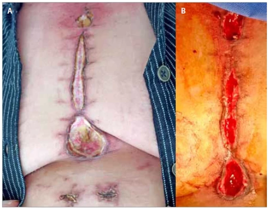 A) Superficial wound infection – post-cardiac transplant; B) after 42 days
of dressing.