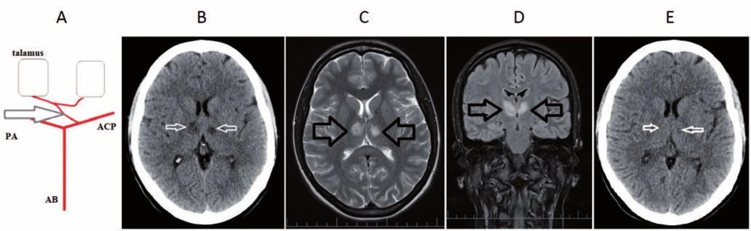 A) Percheronova artéria – anatomický variant v cievnom zásobení talamov. B) CT mozgu s nálezom hypodenzných ložísk
v talame bilaterálne, svedčiace pre čerstvú ischémiu. C, D) MR mozgu T2 sekvencie – C) transverzálne a D) koronárne rezy s nálezom
hyper intenzitných ložísk v paramediálnych častiach oboch talamov asymetrického charakteru, svedčiace pre bilaterálne akútne
ischemické lézie. E) Kontrolná CT mozgu po 7 dňoch, tzv. fogging efekt v oblasti ischémie v paramediálnych častiach talamov bilaterálne.
AB – arteria basilaris; ACP – arteria cerebri posterior; PA – Percheronova artéria<br>
Fig. 1. A) Percheron artery – an anatomical variant in the blood supply of the thalamus on both sides. B) Brain CT scan with the finding
of bilateral thalamic hypodense lesions suggesting acute ischemia. C, D) Brain MRI scan – C) transversal and D) coronal T2-weighted
with the finding of bilateral asymmetrical hyperintense lesions in paramedial area of the thalamus suggesting acute ischemia.
E) Follow-up brain CT scan after 7 days with the finding of a bilateral fogging effect in paramedial areas of the thamalus.
AB – basilar artery; ACP – posterior cerebral artery; PA – Percheron artery