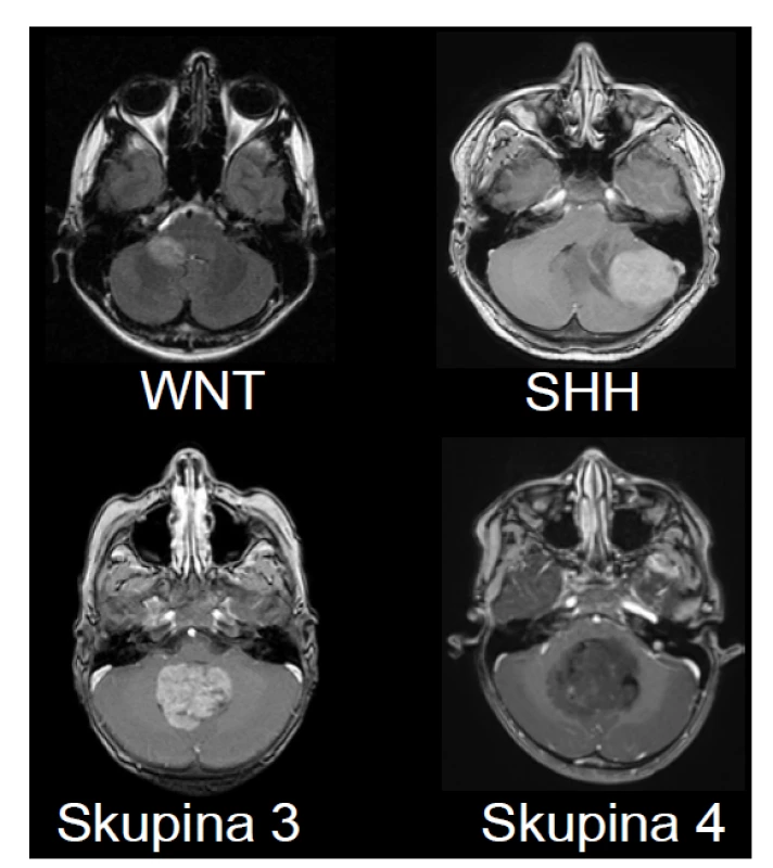 Zobrazení MRI charakteristik jednotlivých podskupin meduloblastomu.
A – Wnt-aktivovaný meduloblastom s extenzí do mostomozečkového
koutu vpravo a do mozečkového pedunklu. B – SHH – aktivovaný
meduloblastom lokalizovaný v levé mozečkové hemisféře. Takové laterální
uložení je charakteristické pro SHH meduloblastom. C – Skupina 3 – tumor
uložený ve vermis a 4. mozkové komoře s výrazným homogenním sycením
po podání kontrastní látky. D – Skupina 4 – uložený ve vermis a 4. mozkové
komoře s absencí sycení po podání kontrastní látky, což je charakteristika
typická pro meduloblastom Skupiny 4.