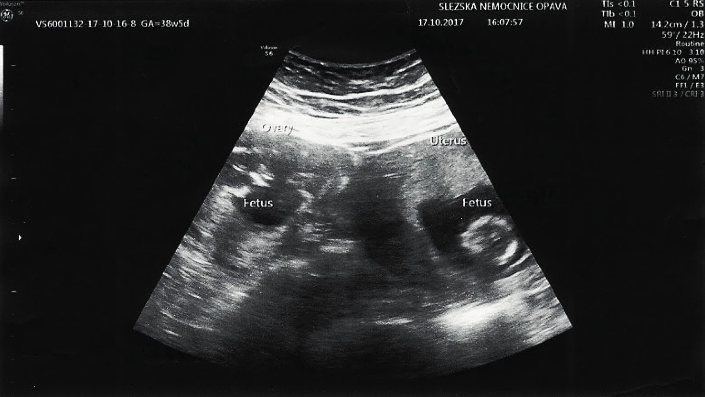 Transabdominální ultrazvuk zobrazující vitální graviditu,
vlevo od dělohy ektopickou tubární vitální graviditu