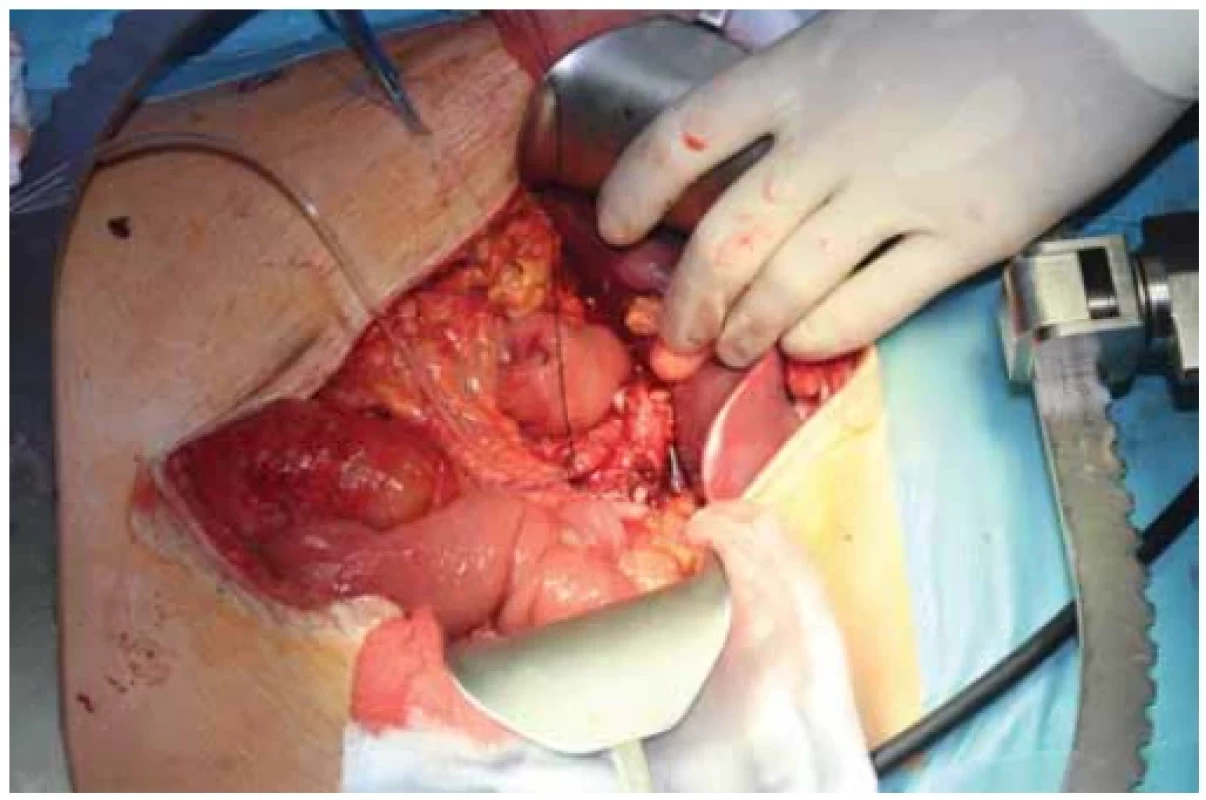 Inzercia kanyly do pahýľa véna lienalis. <br> 
Fig. 5. Insertion of a catheter into rest of vena lienalis.