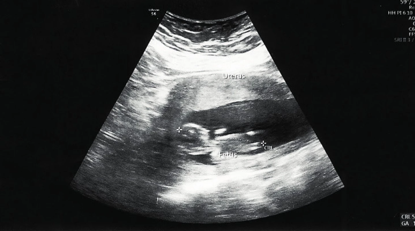Intrauterinní vitální gravidita podle CRL 12+4